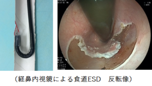 【内視鏡的粘膜下層切開剥離術（endoscopic submucosal dissection：ESD）】