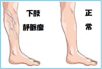 下肢静脈瘤外来