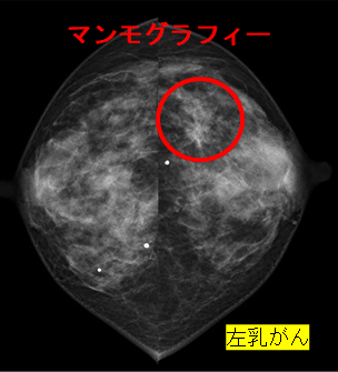 マンモグラフィー1